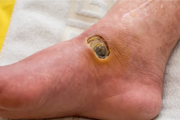 நீரிழிவு புண் சிகிச்சை