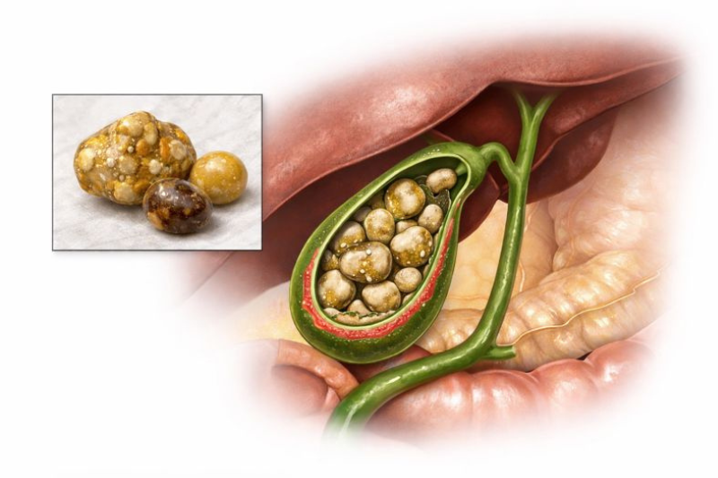 பித்தப்பை கல் சிகிச்சை