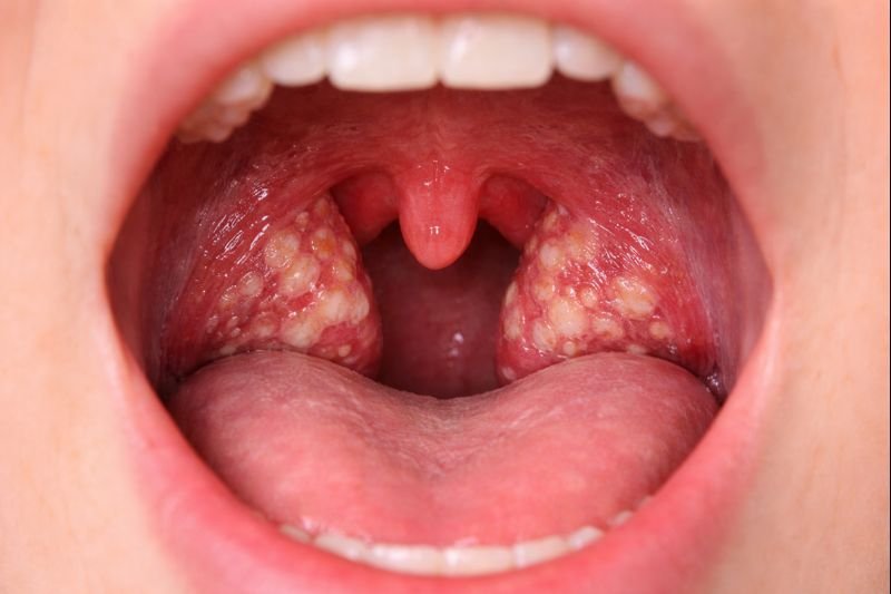 டான்சிலைட்டிஸ் சிகிச்சை